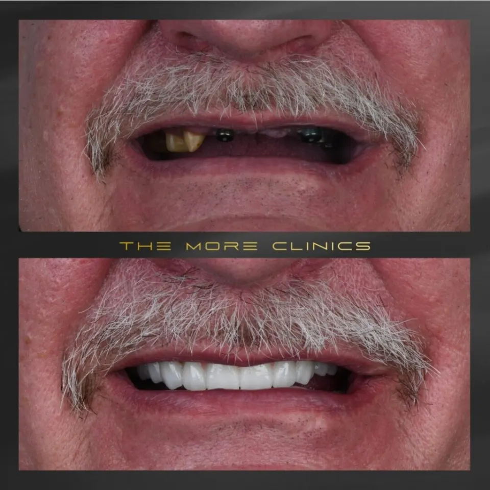 Dental before & after 7