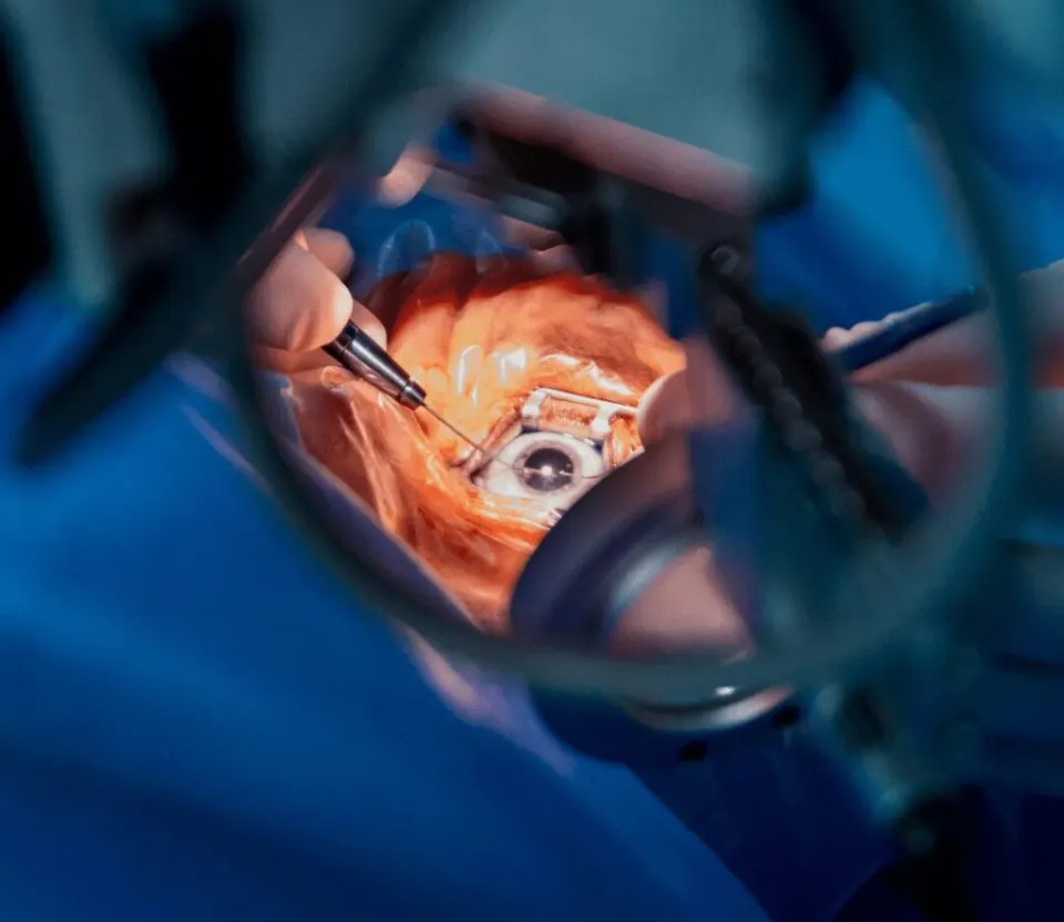Cataract Surgery Turkey