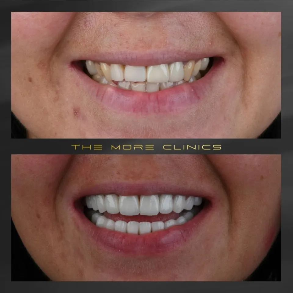 Dental before & after 38
