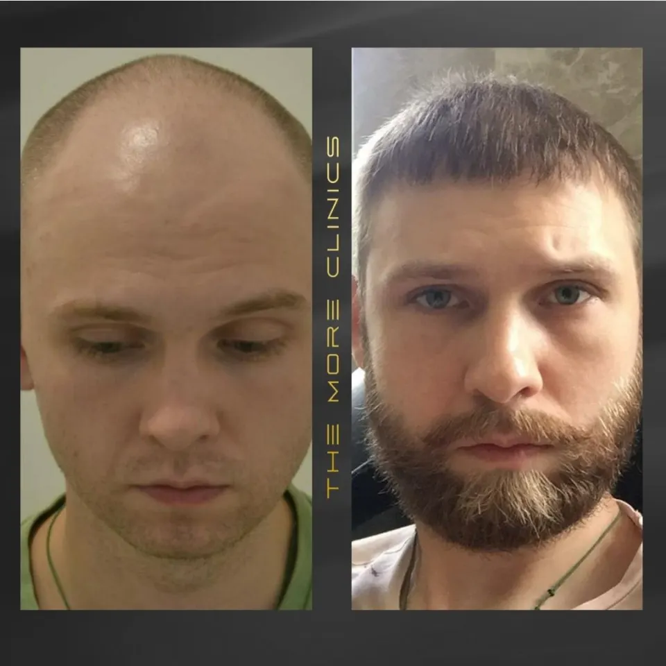 Hair before & after 11