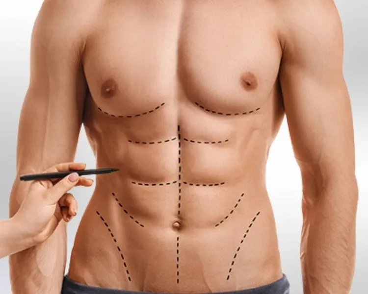 abdominal etching 6-pack-surgery candidate man standing