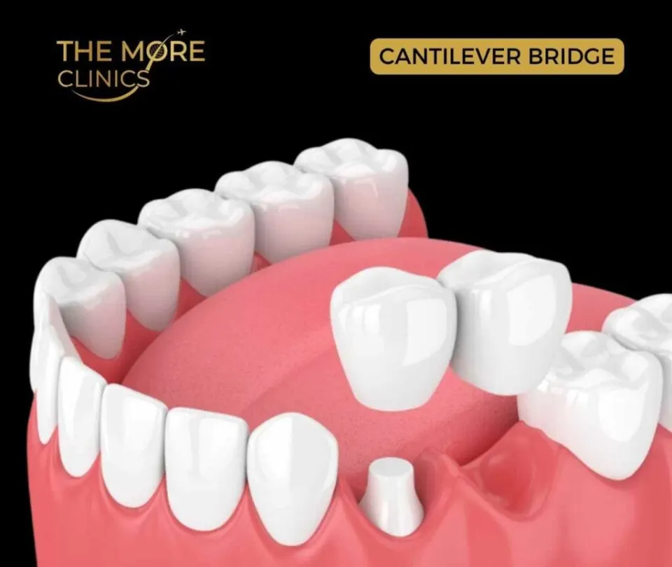Cantilever bridge dental — single abutment tooth bridge cost