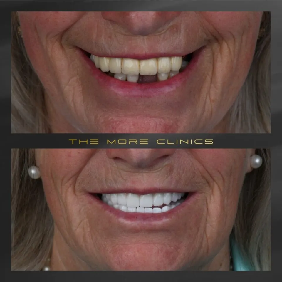 Dental implants and crowns Turkey before and after