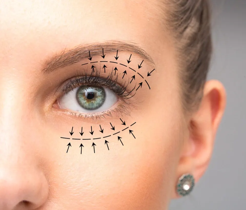 BLEPHAROPLASTIK AUGENLIDOPERATION TÜRKEI