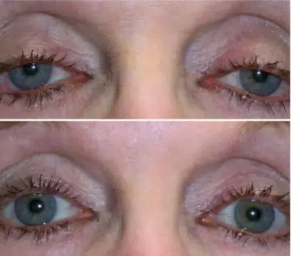 botched eyelid surgery