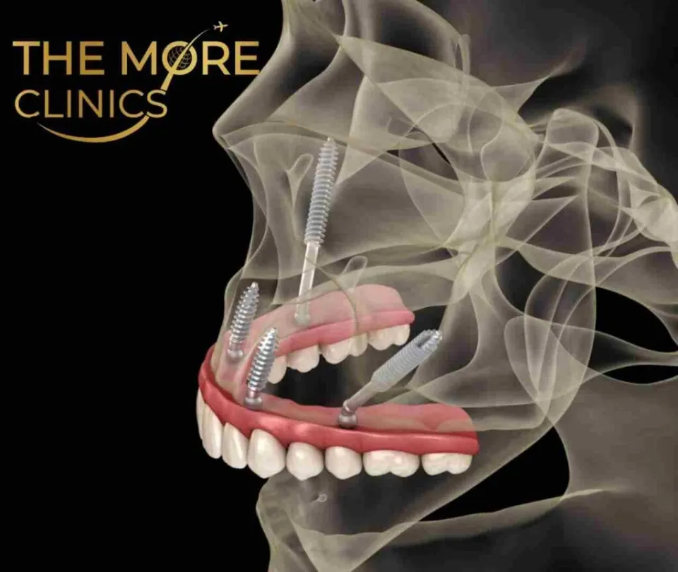 Zygomatic Implants in Turkey: Fixed Teeth Without Bone Grafting