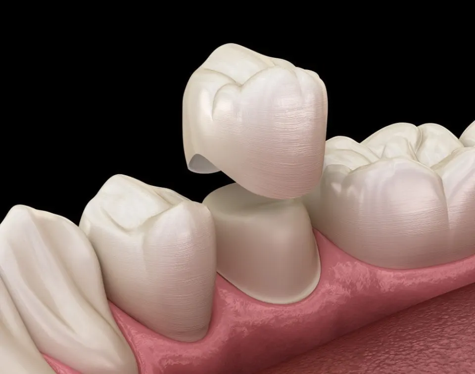 Antalya Dental Crowns