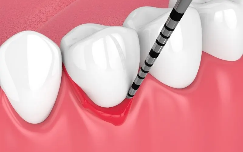 Periodontitis — stages, symptoms and treatment guide 2026