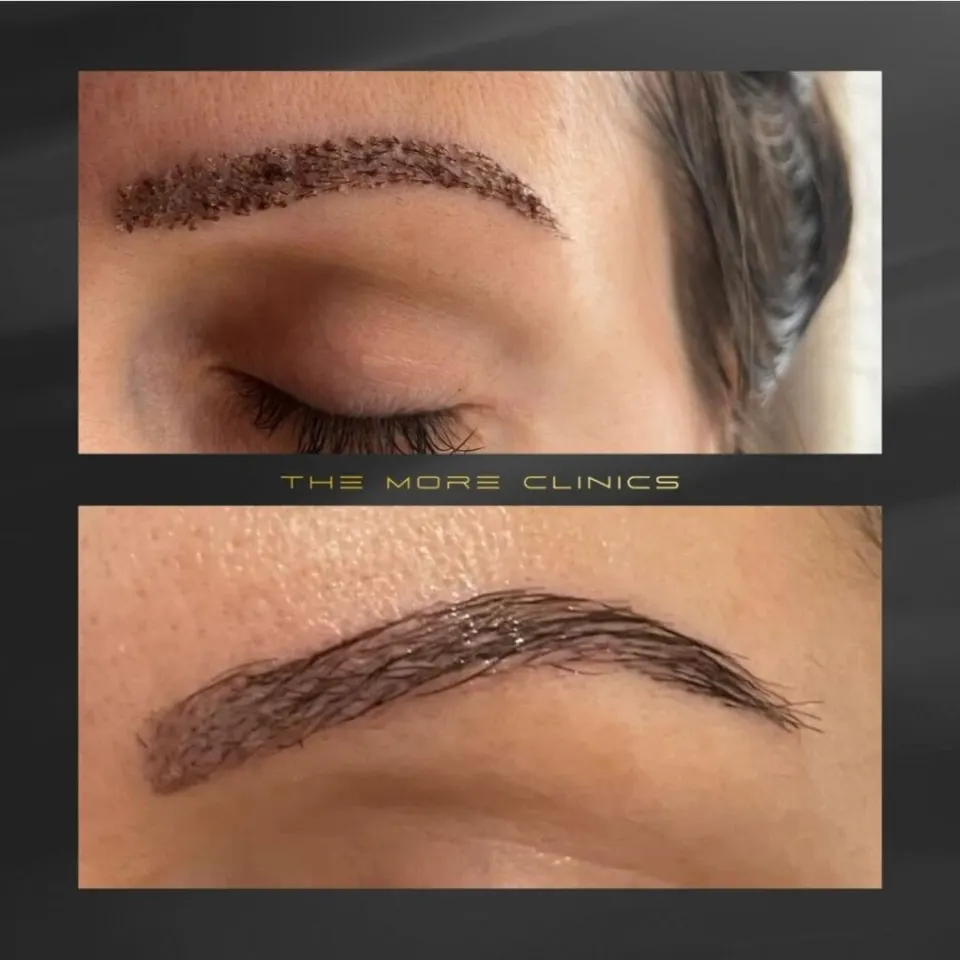 Greffe de sourcils à Antalya avant et après