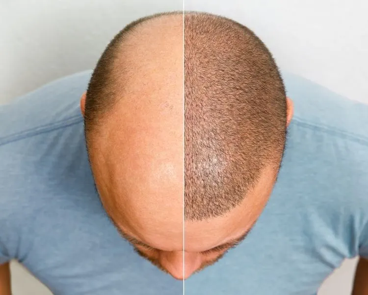 Antalya DHI Hair Transplant